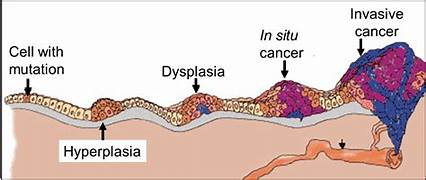 In situ Carcinoma